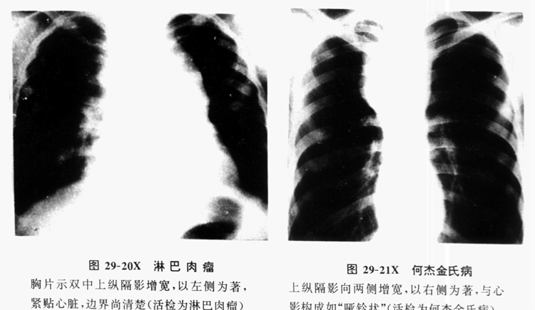 淋巴瘤