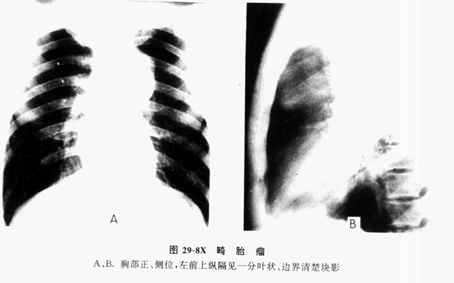 畸胎瘤