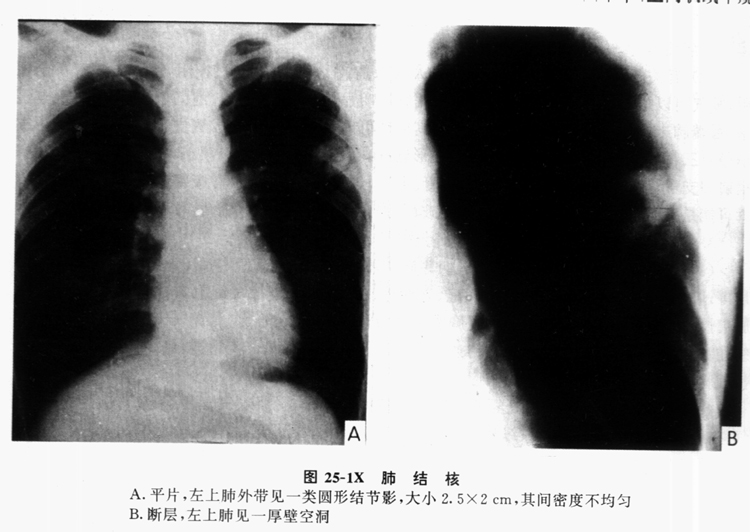 空洞型肺结核