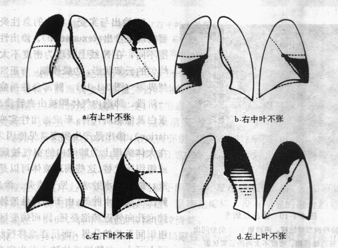 肺不张
