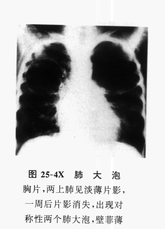 肺大泡