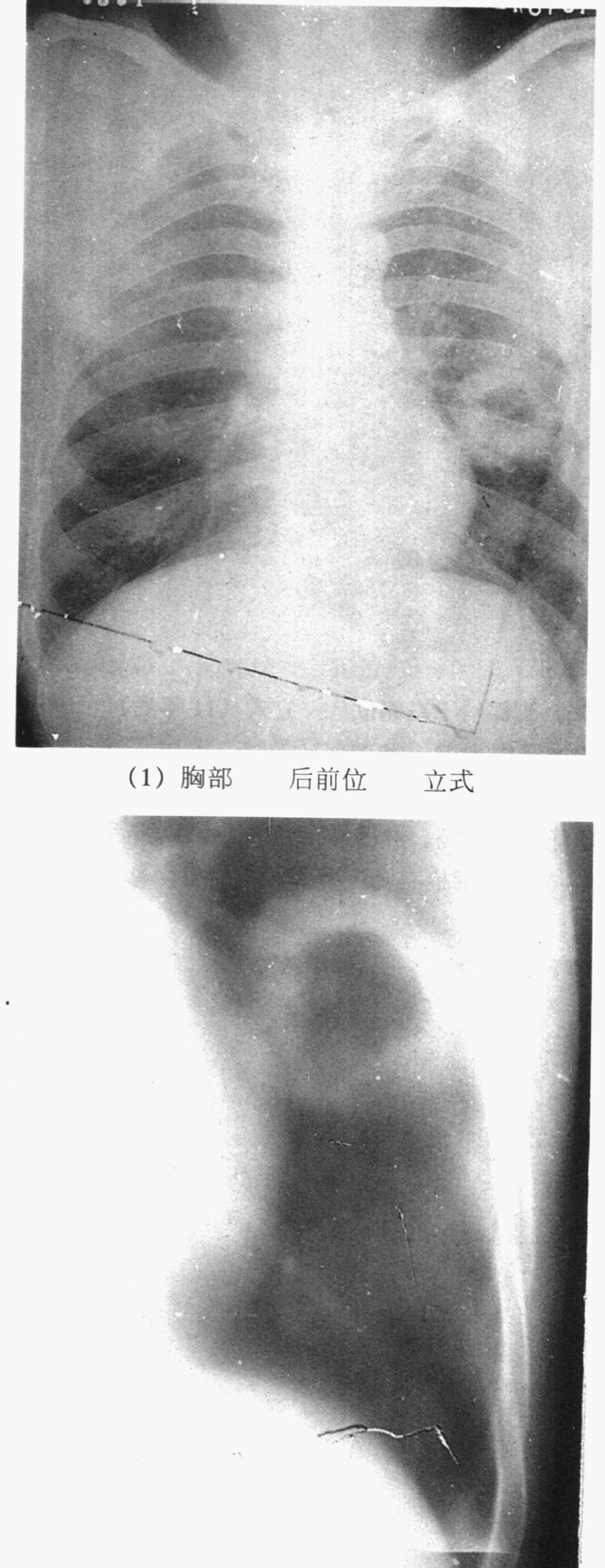肺癌空洞