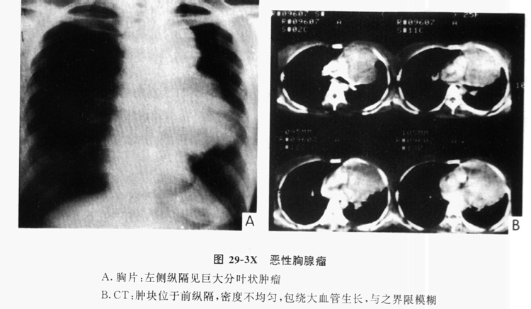 胸腺瘤