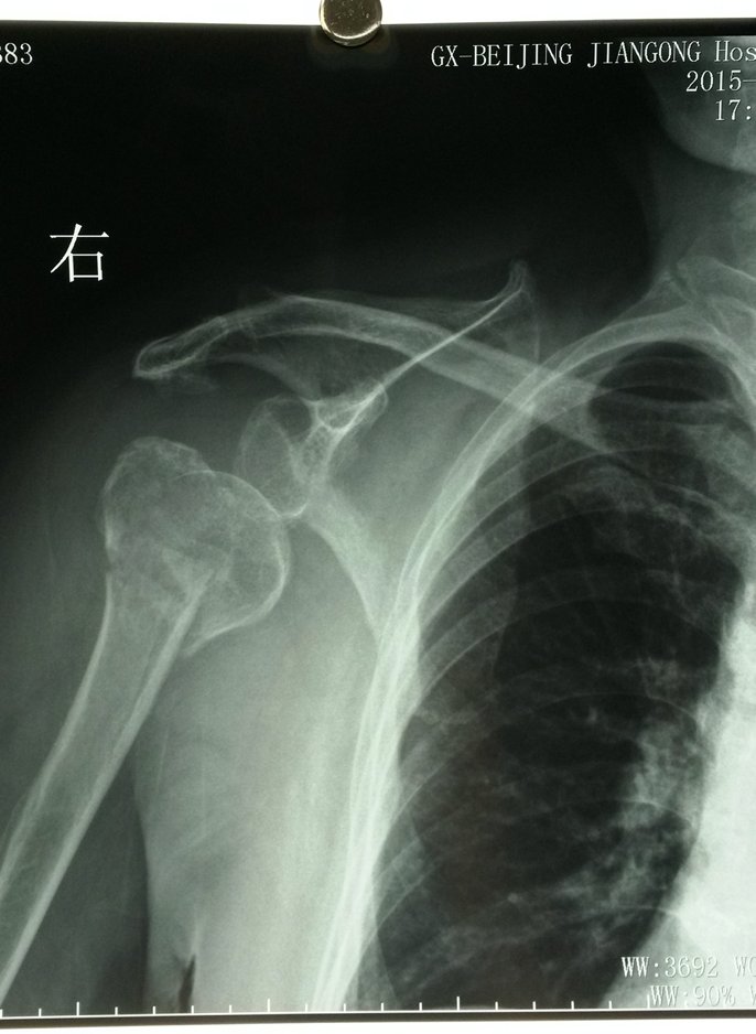肱骨外科颈骨折影像1